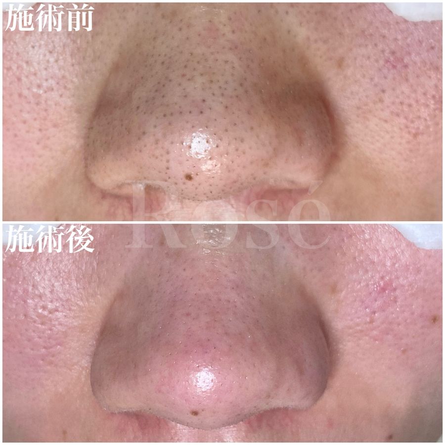 鼻まわりの毛穴ケア施術前と施術後の比較写真。施術後は毛穴の黒ずみ・詰まりが目立たなくなっている